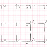 A Case Of Lown Ganong Levine Syndrome Due To An Accessory Pathway Of James Fibers Or Enhanced Atrioventricular Nodal Conduction Eavnc Article Abstract American Journal Of Case Reports A Case Of Lown Ganong Levine Syndrome Due To An Accessory Pathway Of James Fibers Or Enhanced Atrioventricular Nodal Conduction Eavnc Article Abstract American Journal Of Case Reports