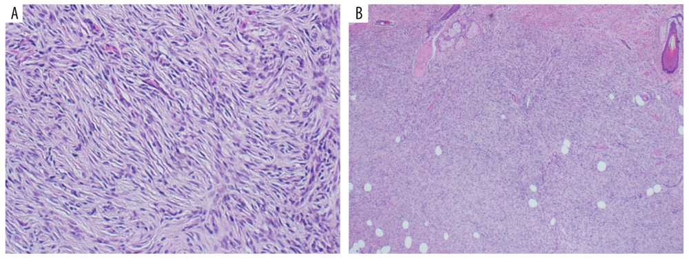 (A) High power showing spindle cells forming slit like spaces and microcapillaries, 40×; and (B) low power view showing nodular pattern of dermal growth with dilated crescentic vascular spaces consisting with Kaposiform hemangioendothelioma.