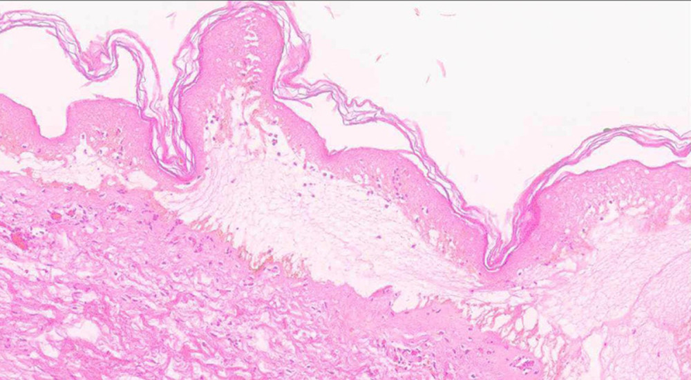 Biopsy of lesion taken on initial presentation demonstrating lichenoid dermatitis with subepidermal cleft and erythrocyte extravasation highly suggestive of hemorrhagic bullous LS (100× magnification).