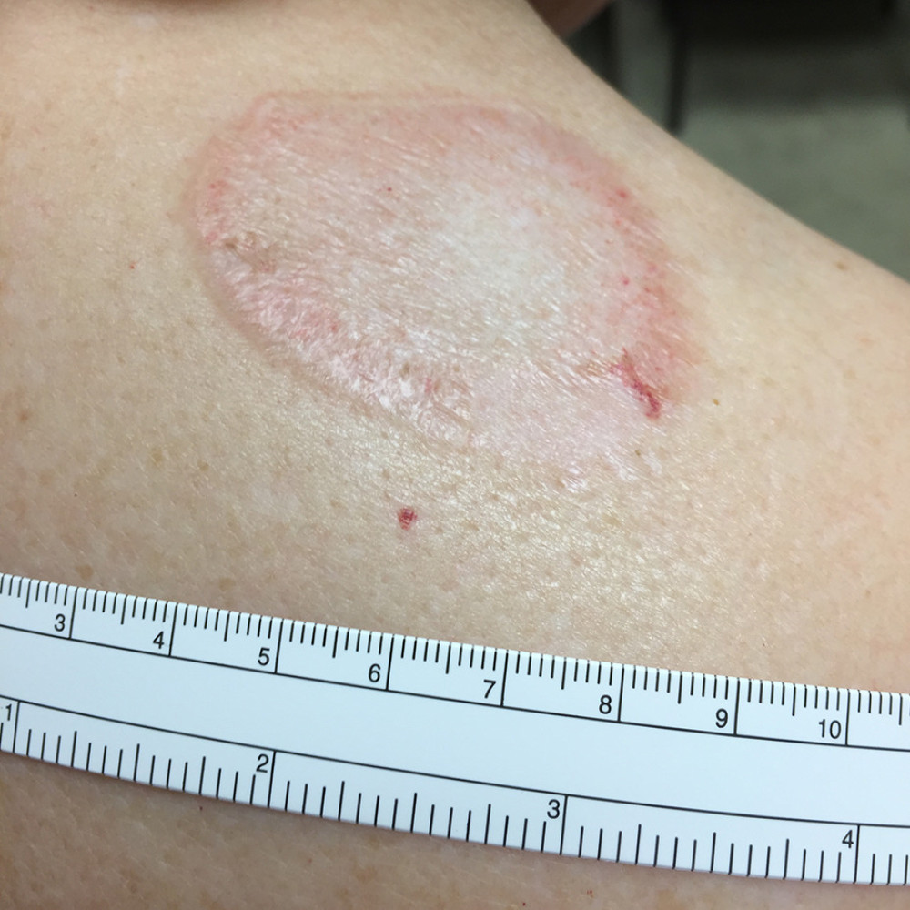Hemorrhagic bullous LS after 6 months of treatment with topical betamethasone.