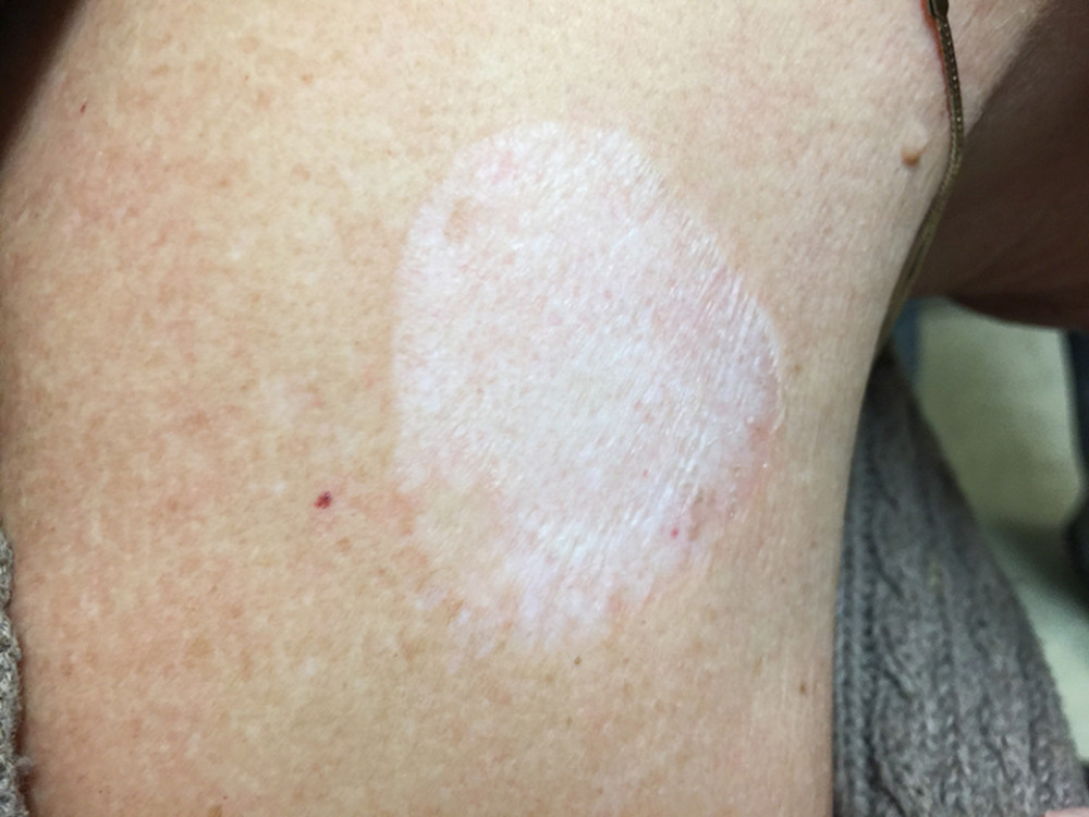 Hemorrhagic bullous LS after 15 months of treatment with topical betamethasone.