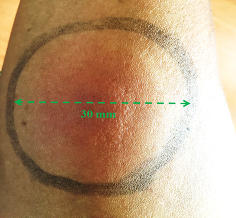 Positive tuberculin skin test. Highly positive tuberculin skin test with an induration diameter of 30 mm, revealing an inflammatory, erythematous, and phlyctenular reaction.