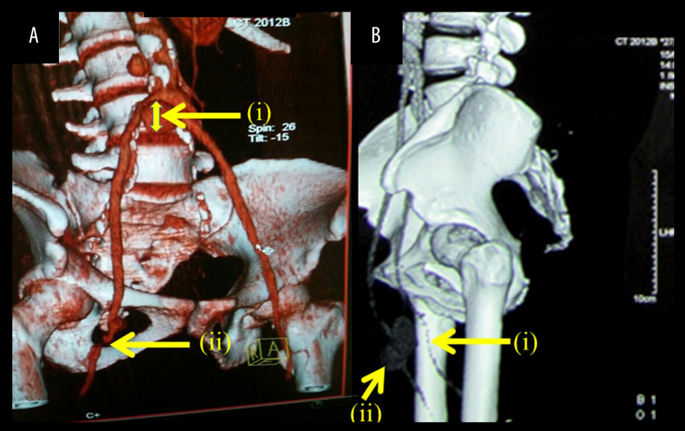 Arterial ectasia and stenosis of lower limbs. (A) Angio-computed tomography (Angio-CT) showing an ectasia of the renal abdominal aorta over 7 cm in length and 31 mm in diameter at the bifurcation. (B) Angio-computed tomography (Angio-CT) showing significant stenosis of iliac arteries.