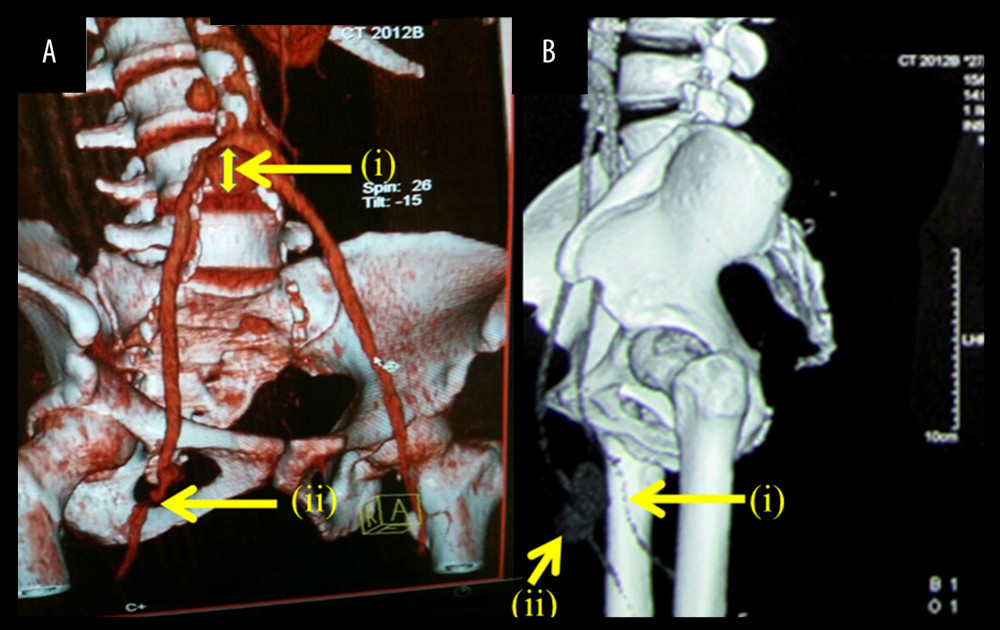 Arterial ectasia and stenosis of lower limbs. (A) Angio-computed tomography (Angio-CT) showing an ectasia of the renal abdominal aorta over 7 cm in length and 31 mm in diameter at the bifurcation. (B) Angio-computed tomography (Angio-CT) showing significant stenosis of iliac arteries.
