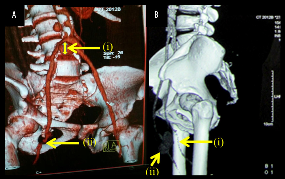 common iliac artery ectasia