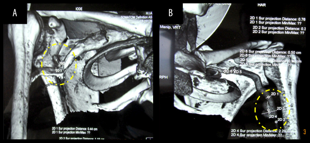 Aneurysm on axillary arteries. (A) (Right axillare) Angio-computed tomography (Angio-CT) showing a 3-cm aneurysm on the right axillary artery. (B) (Left axillare) Angio-computed tomography (Angio-CT) showing a 4-cm aneurysm on the left axillary artery.