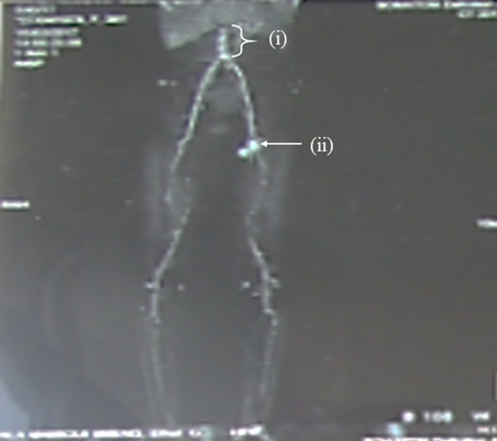 Saccular aneurisms and thrombosis of the abdominal aorta and lower limbs. Saccular aneurisms of the abdominal aorta (one of them 22×20 mm) on the lateral part of the infra-renal abdominal aorta with thrombosis (i). Aneurysm after the bifurcation on the right iliac artery, measuring 30×25 mm (ii).