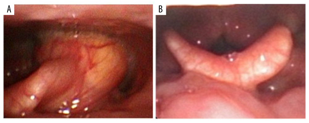 Laryngoscopy pre- (A) and post- (B) surgical treatment.