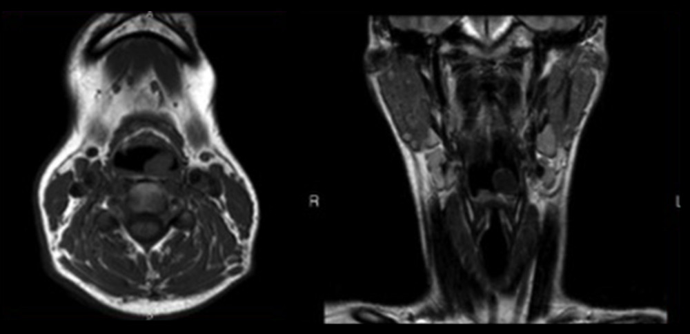 Magnetic resonance imaging performed whit T1wTSE-, T2wTSE-, STIR, and THRIVE weighted sequences.