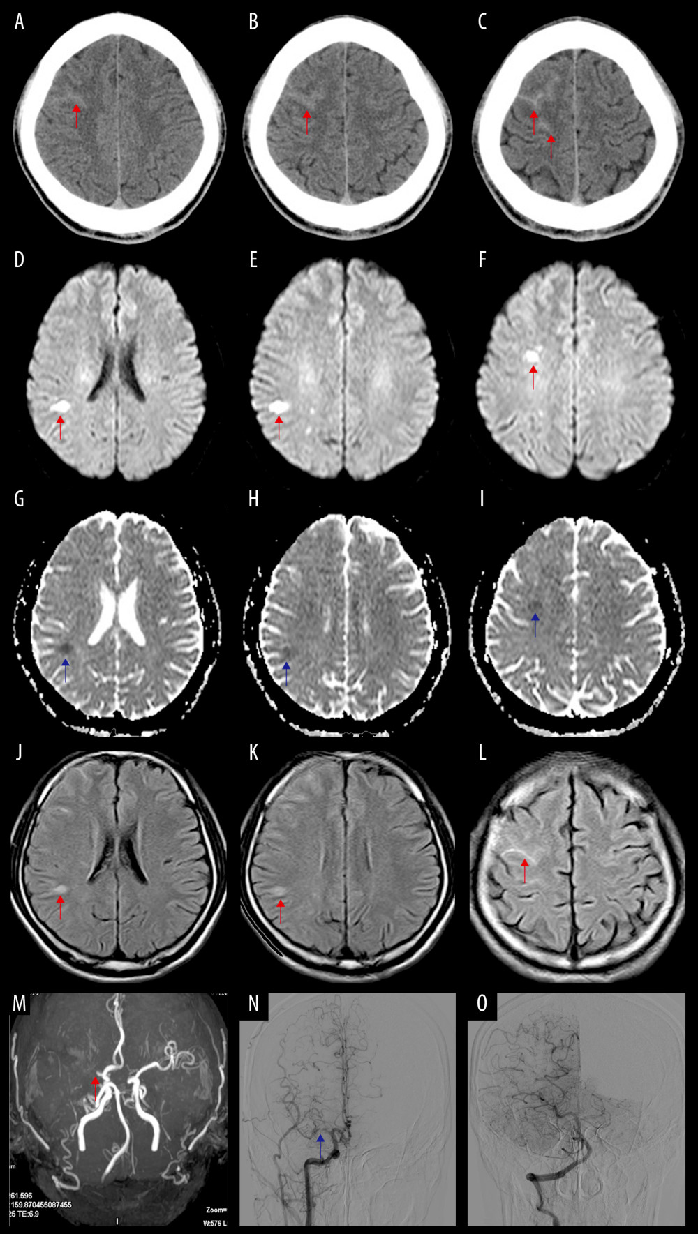 (A–C) Axial brain CT shows cortical subarachnoid hemorrhage in the right superior frontal sulcus (red arrow). (D–F) Axial diffusion-weighted image (DWI) shows acute ischemic infarction in the right frontal lobe and corona radiata (red arrow). (G–I) The apparent diffusion coefficient (ADC) shows acute ischemic infarction in the same location (right frontal lobe and corona radiata) (blue arrow). (J, K) Axial FLAIR shows acute ischemic infarction in the right frontal lobe (red arrow). (L) Axial FLAIR shows cSAH in the right superior frontal sulcus (red arrow). (M) Discloses the M1-segment of the right middle cerebral artery (MCA) occlusion (red arrow), a bilateral anterior cerebral artery from the right internal carotid artery (RICA), fetal posterior cerebral artery (PCA), and a hypoplastic left vertebral artery. (N, O) DSA shows severe stenosis in the M1-segment of the right MCA (N, blue arrow), and shows the normal cerebral arteries in the right posterior circulation (O).
