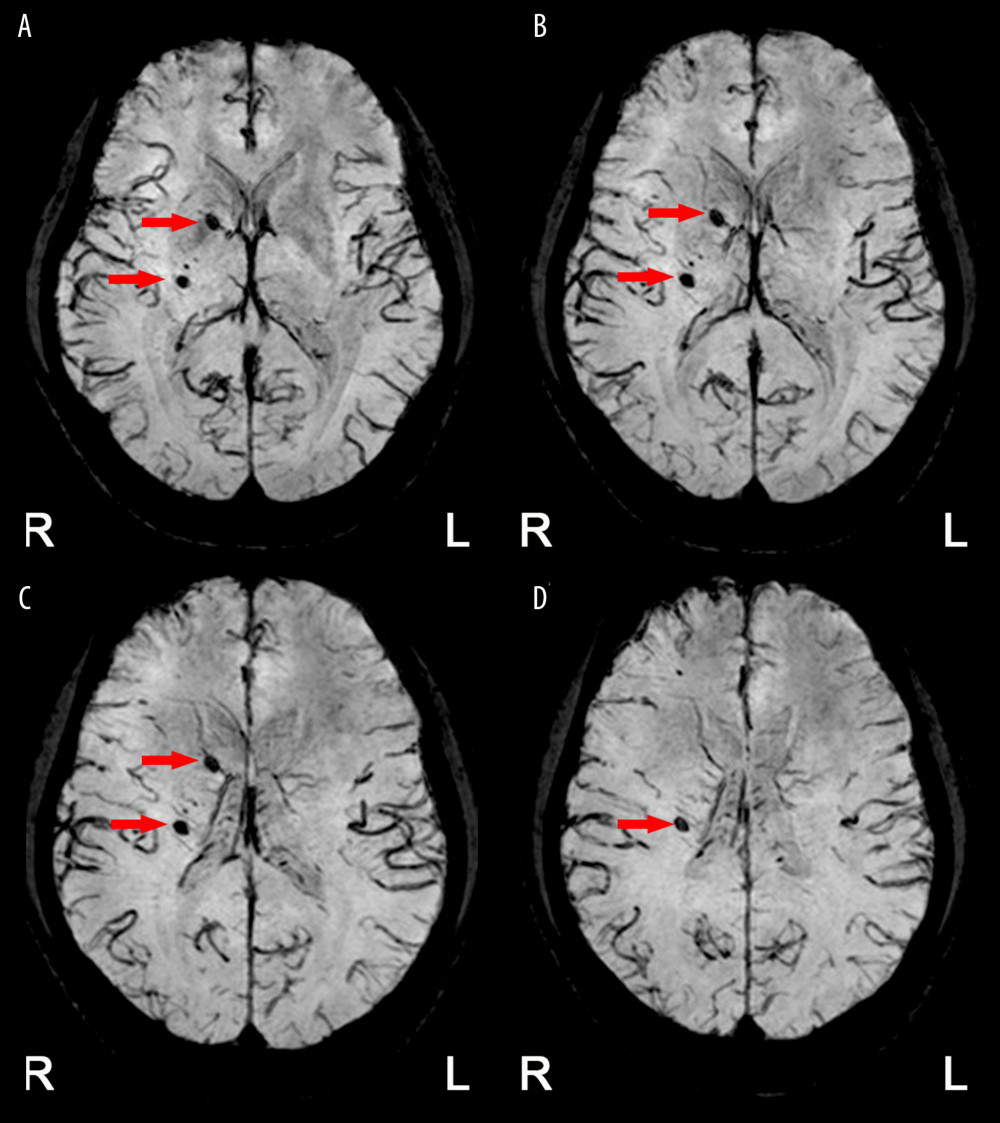 (A–D) Axial SWI shows microbleeds in the right frontal lobe, temporal lobe, basal ganglia and thalamus (red arrow).