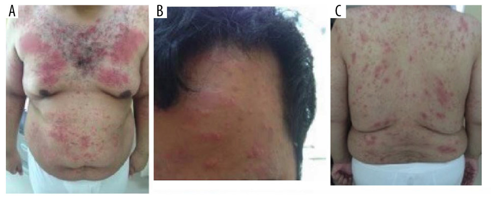 Case 1: Widespread rash 3 weeks after surgery. Erythematous maculopapular rash on the chest and abdomen (A), forehead (B), and back (C).
