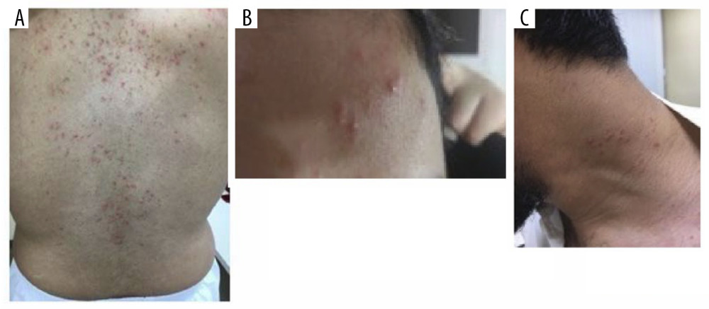 Case 2: Presentation before treatment. Erythematous papules on the back (A), forehead (B) and left side of the neck (C).