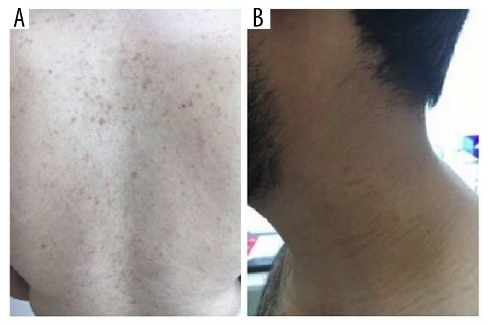 Case 2: Presentation after treatment. Improvement of the skin rash with resolution of the papules, as shown in both the back (A) and the left side of the neck (B).