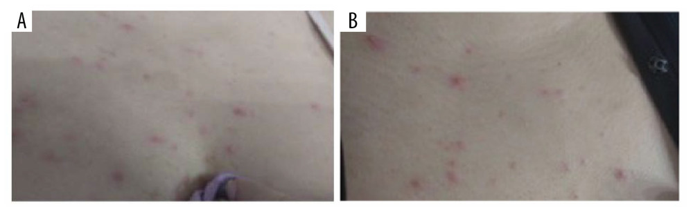 Case 3: Presentation before treatment. Papular rash on the chest (A, B).