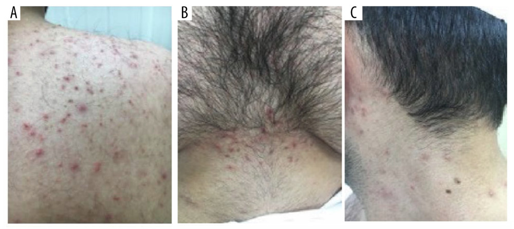 Case 4: Presentation before treatment. Maculopapular rash on the back (A), chest (B) and left side of the neck (C).