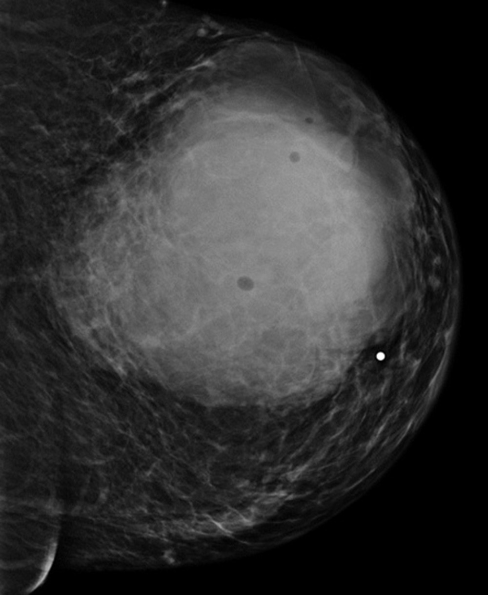 Mammogram showing a 10×10 cm mass in the left breast classified as BI-RADS category 4.