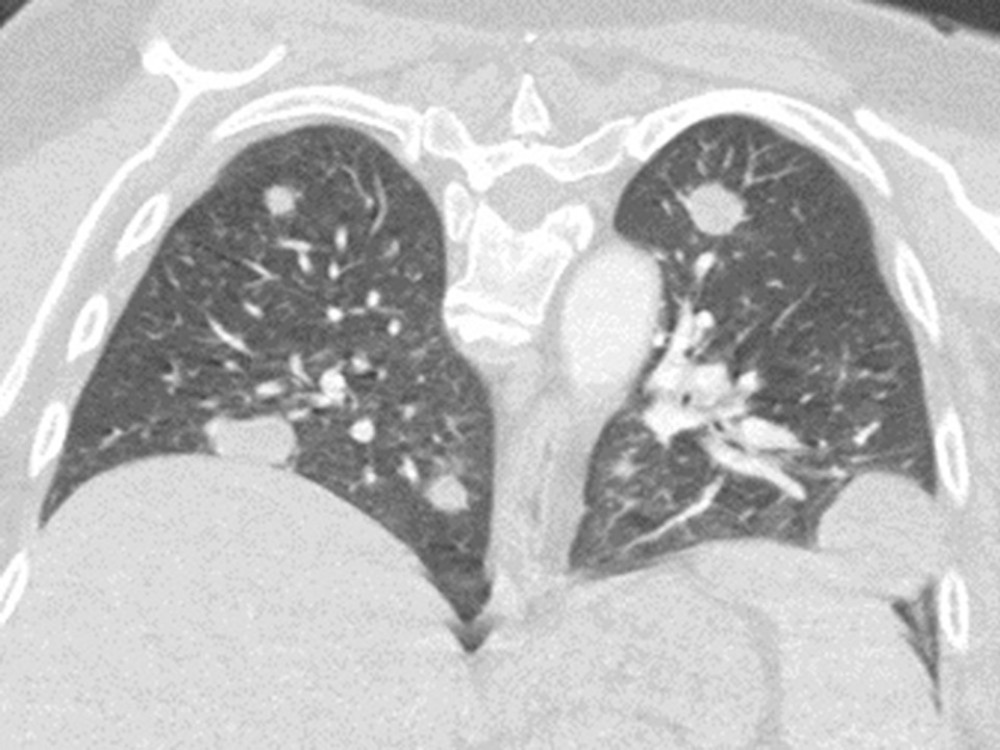 CT of the chest with contrast, showing pulmonary metastases.