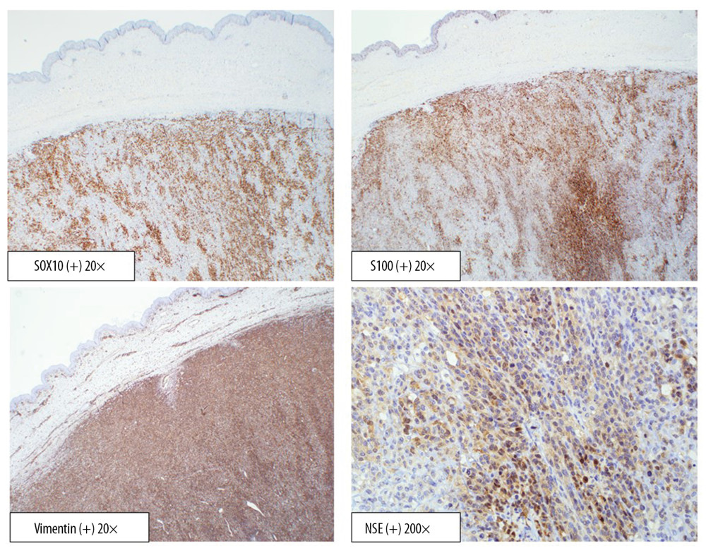 Immunohistochemical markers positive in a biopsy of the left breast.