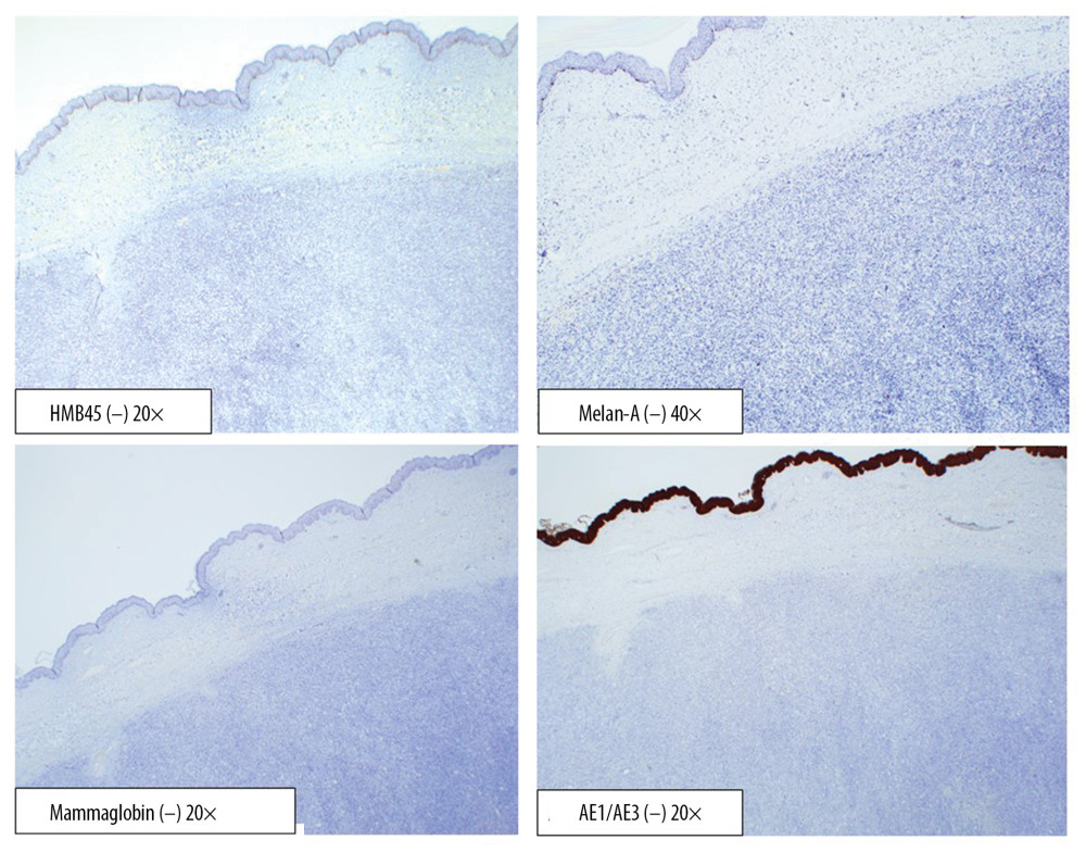 Immunohistochemical markers negative in a biopsy of the left breast.