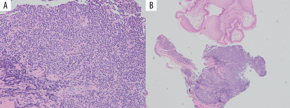Gastroesophageal biopsy showing H&E staining of submucosal tumor composed of lymphocytes and plasma cells. (A) 20× and (B) 10×.