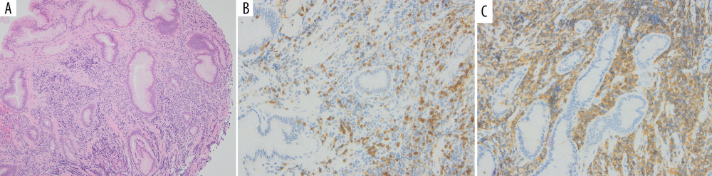 Gastroesophageal biopsy showing transitional mucosa with no evidence of lymphoepithelial lesion (LEL) on CD staining and normal number of intraepithelial CD3 cells. (A) H&E, (B) CD20 with no LEL, and (C) CD3 intraepithelial lymphocytes.