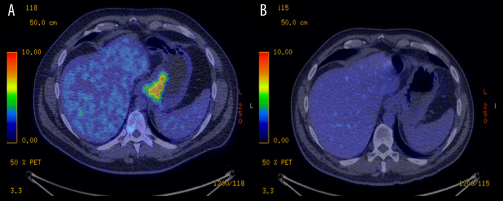 PET/CT scan: (A) Pre-treatment and (B) Post-treatment.