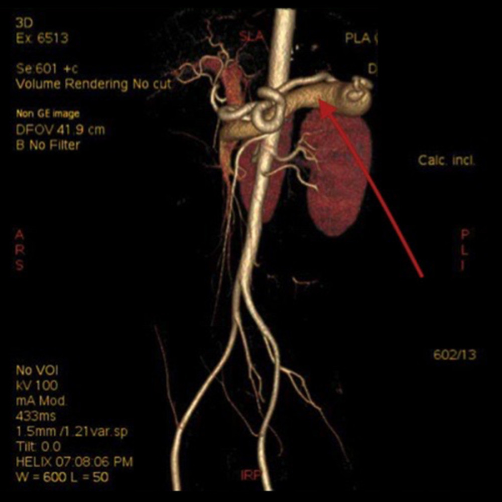 Contrast-enhanced abdominal computed tomography reconstruction shows dilated splenic vein, tortuous splenic vein, and splenic arteriovenous fistula.
