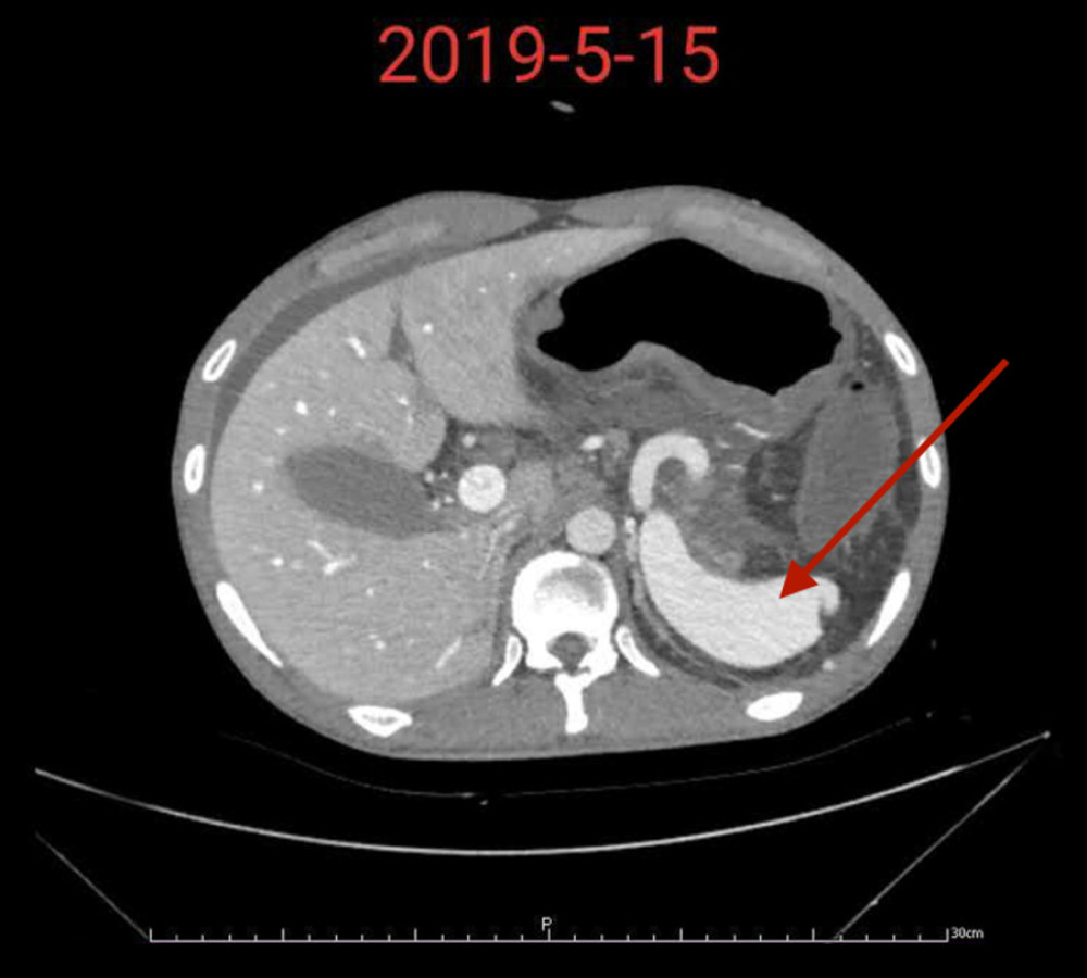 Tortuous splenic vein indicated by arrow in contrast-enhanced CT.