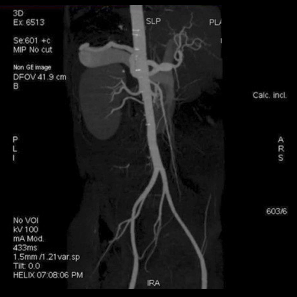 Splenic arteriovenous fistula shown by celiac angiography.