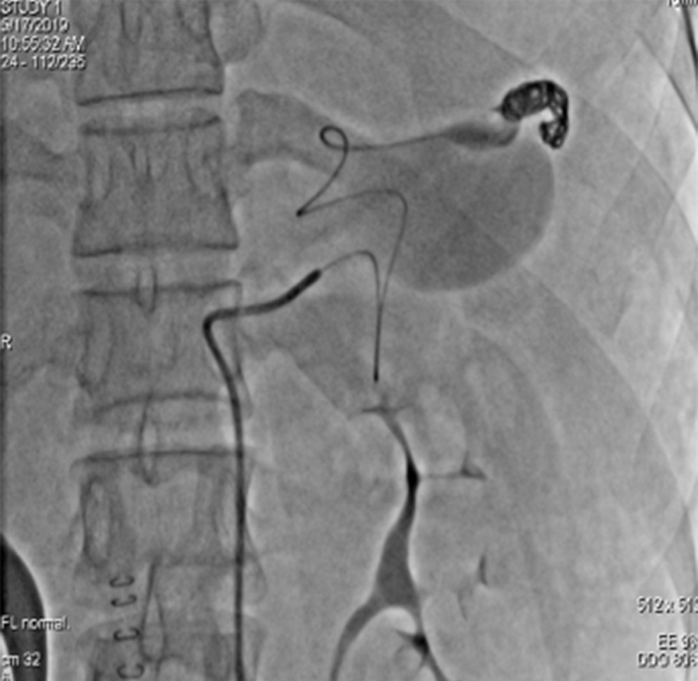 Endovascular treatment using a 7-F balloon to block the splenic artery, and 3-F microcatheter carefully inserted into the distal end of the splenic artery for embolization.