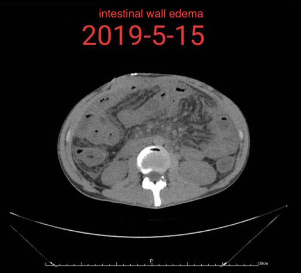 Intestinal wall edema caused by portal hypertension.