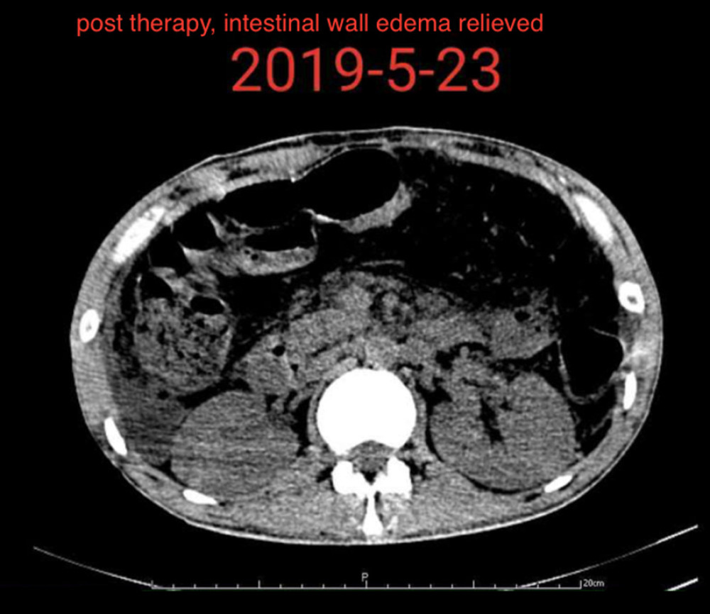 Intestinal wall edema relieved after splenic artery endovascular embolization therapy.