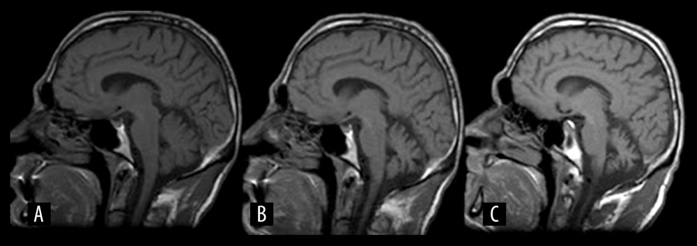 Sagittal cerebral T1-weighted magnetic resonance imaging (MRI) sequences in a 44-year-old man with paraneoplastic cerebellar degeneration (PCD) who developed classical mixed cellularity Hodgkin’s lymphoma 16 months later. (A) Sagittal cerebral T1-weighted MRI at one month (B), two months, and (C) at sixth months after clinical onset. Cerebral MRI shows cortical and subcortical atrophy at the supratentorial and infratentorial levels and marked cerebellar atrophy.