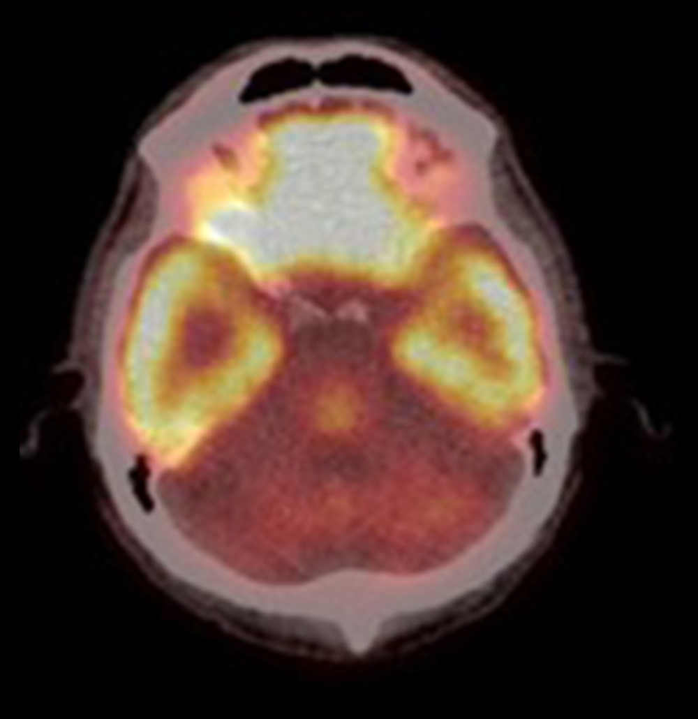Axial cerebral imaging with 18-fluorodeoxyglucose (FDG) positron emission tomography and computed tomography (PET-CT) shows a reduction of metabolic activity in the cerebellum in a 44-year-old man with paraneoplastic cerebellar degeneration (PCD) who developed classical mixed cellularity Hodgkin’s lymphoma 16 months later.