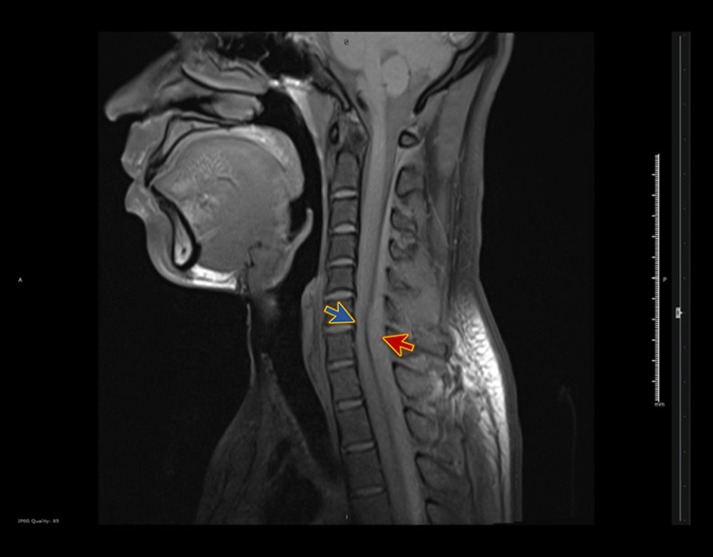 Magnetic resonance imaging with contrast, sagittal view whole spine. The figure shows acute spinal subdural canal hematoma (red arrow), producing cord compression (blue arrow) at the C6–C7 level.