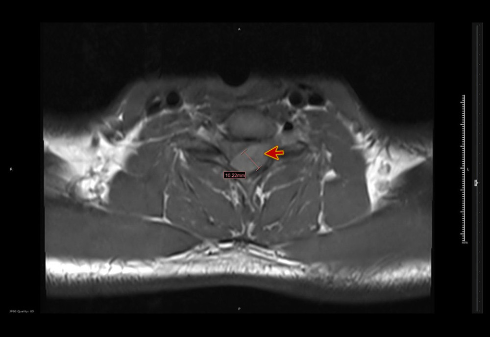 Magnetic resonance imaging with contrast, transverse view whole spine. The figure shows severe cord compression, with a left-side posterolateral intraspinal extramedullary lesion outside the thecal sac (red arrow).
