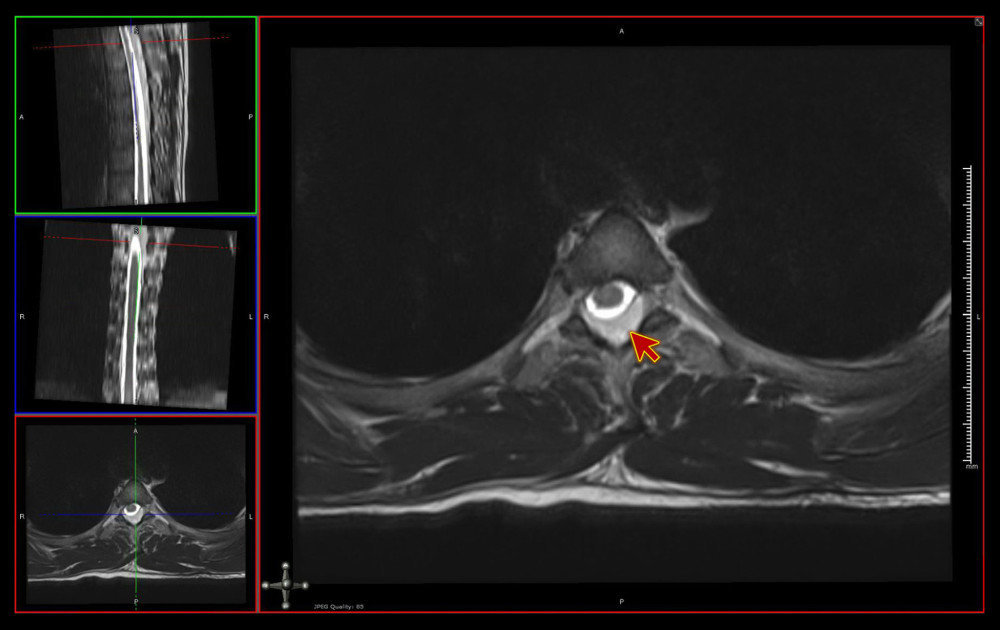 Magnetic resonance imaging with contrast, transverse view whole spine. The figure shows the gradient-echo sequence and hypodensities within the lesion, suggestive of blood products (red arrow).