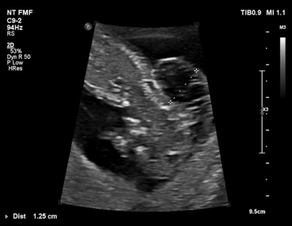 Ultrasound scan for first fetus at 12+3 weeks with cystic hygroma.