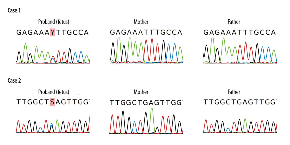 The DNA sequence electropherogram of the PTPN11 variants of the described probands and their parents. Case 1: PTPN11: c.211T>C, p.Phe71Leu de novo variant. Case 2: PTPN11: c.226G>C, p.Glu76Gln de novo variant.