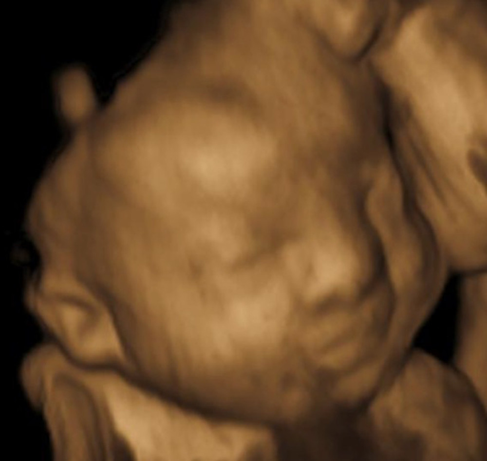 Fetal facial dysmorphism at 33+0 weeks of gestation: prominent forehead, broad nasal bridge, hypertelorism, and low set, posteriorly rotated ears.