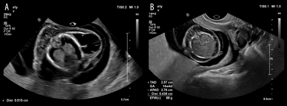 Ultrasound scan results for second fetus. (A) Cystic hygroma at 13+6 weeks; hydrothorax/chylothorax. (B) Subcutaneous generalized edema (abdominal circumference plane).