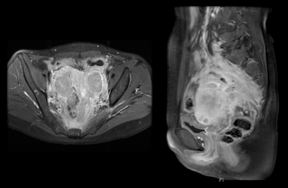 MRI with contrast media showed the pelvic mass, which was considered as malignant before surgery.