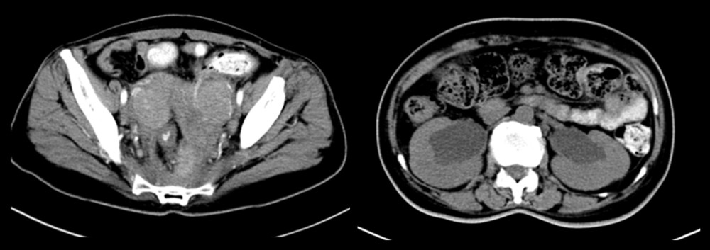 CT showing the pelvic mass and retro-renal pyelectasia.
