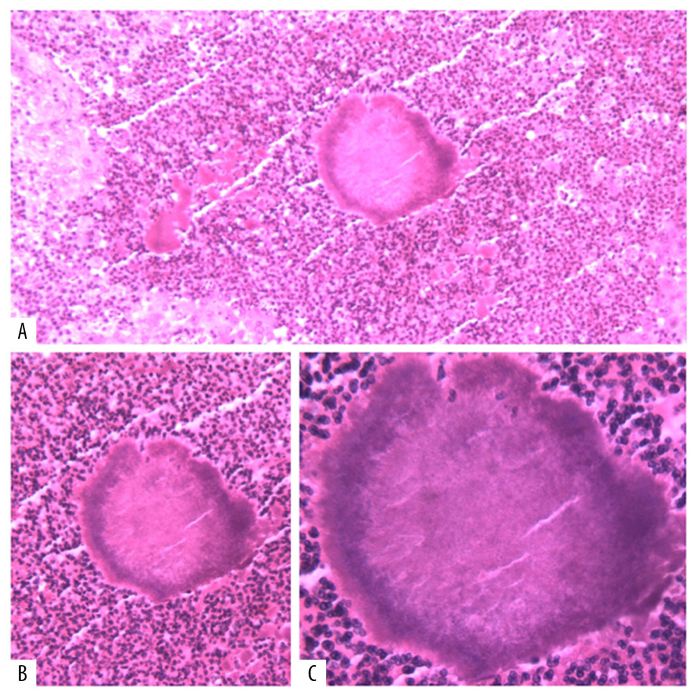 Actinomycete colony can be seen under 100× (A), 200× (B), and 400× (C) under an optical microscope, with surrounding neutrophil infiltration.