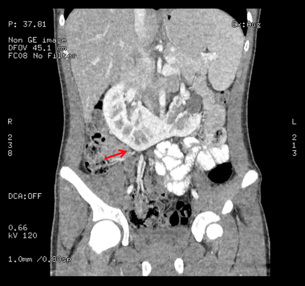 Computed tomography angiography showing the incidental finding of a horseshoe kidney (red arrow).