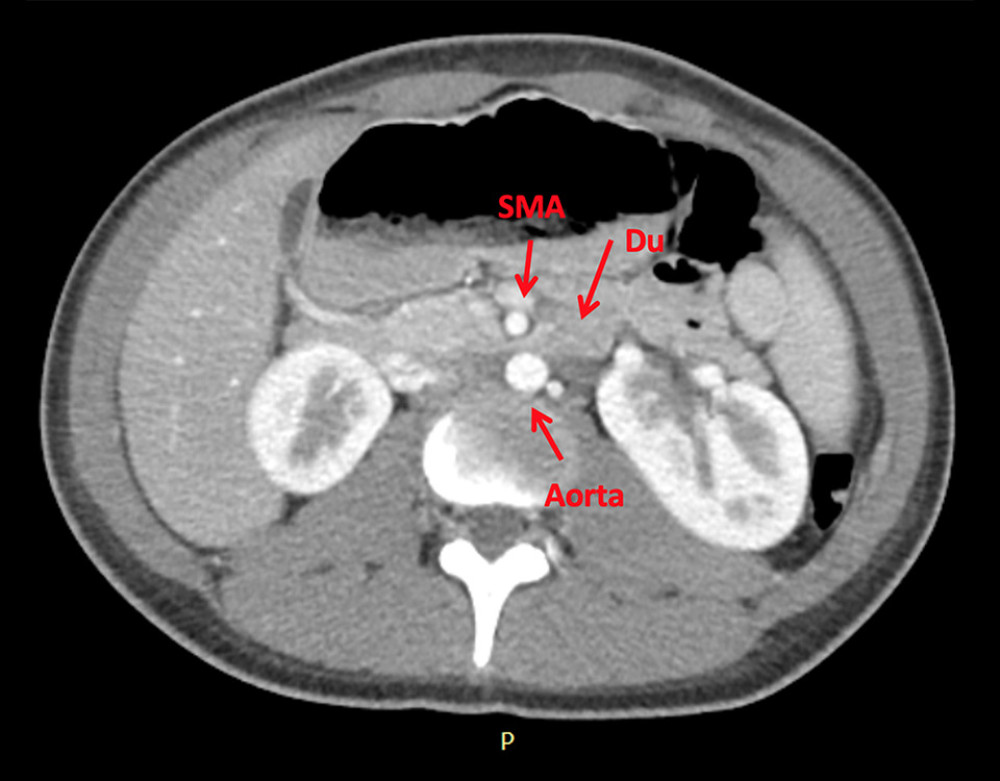 Computed tomography angiography showing the compression of the duodenum (Du) between the superior mesenteric artery (SMA) and the aorta.
