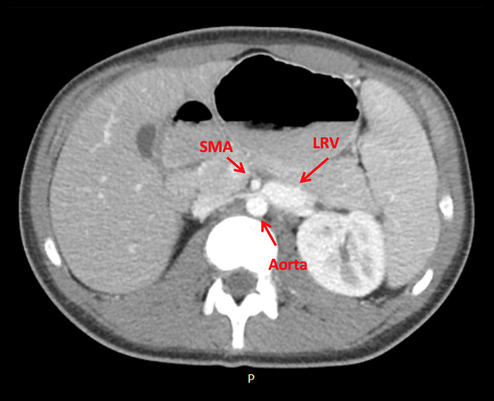 Computed tomography angiography showing the left renal vein (LRV) compression between the superior mesenteric artery (SMA) and the aorta.