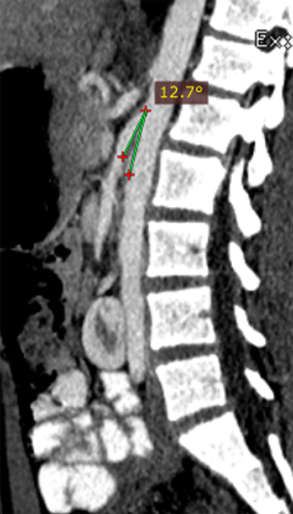 Sagittal computed tomography angiography showing the acute takeoff of the superior mesenteric artery from the aorta at an angle of 12.7 degrees.