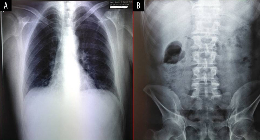 (A) Chest (posterior-anterior view); (B) abdominal x-rays (erect position) demonstrating the absence of free intraperitoneal air.